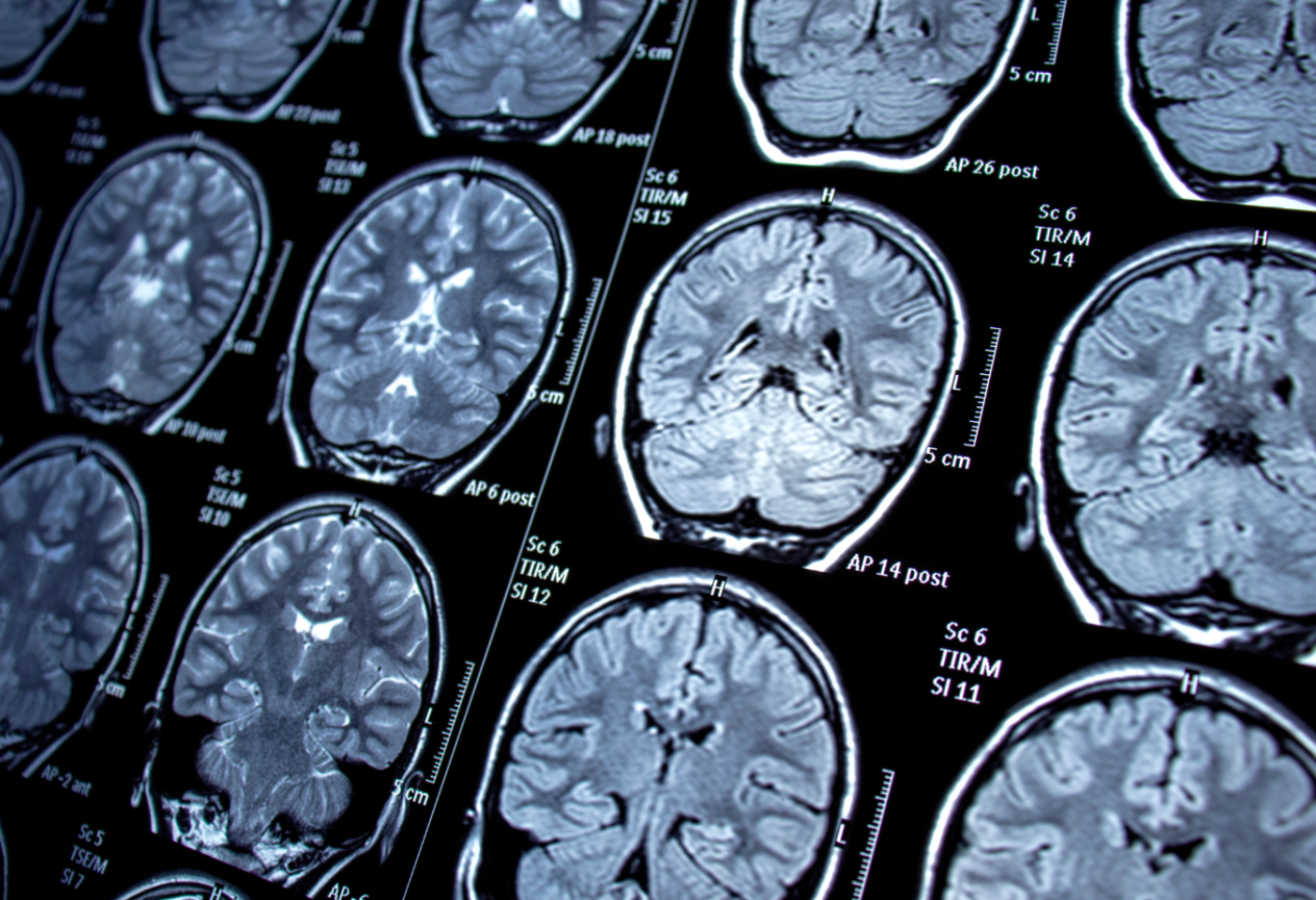 Epilepsie bij kinderen symptomen en diagnose Sophi